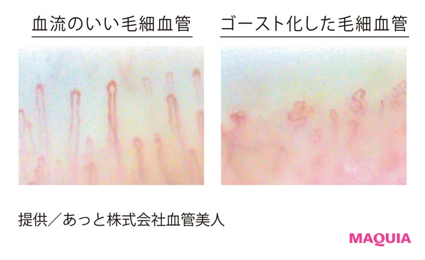自分の毛細血管の状態は、『血管ナビ』掲載の薬局で調べられる(無料)。