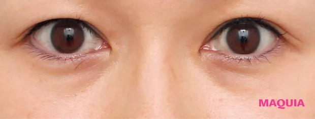 たるみくまにおすすめの美容医療の治療 下眼瞼脱脂術（結膜側） 下眼瞼脂肪注入 ビフォー