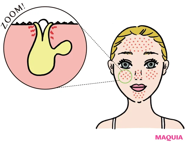 Tゾーンだけでなく頬にもポツポツと毛穴が目立ち、くすんで見える。