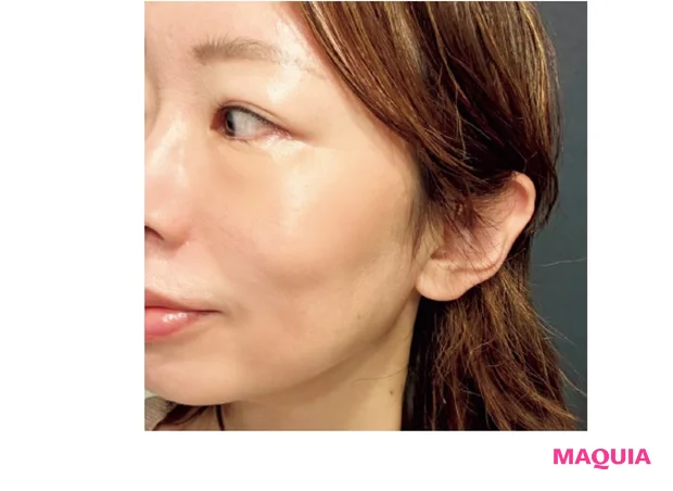 目元がふっくらしてハリが復活しました