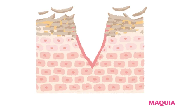 体の重みでバリア機能が乱れ、皮膚に亀裂が！