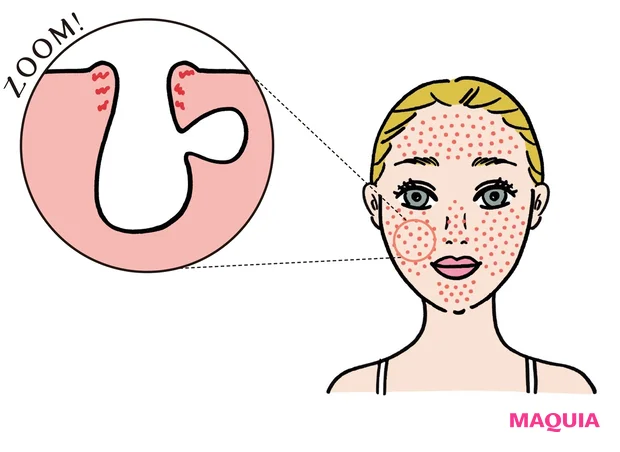 触りすぎた部位に目立つので、人により様々だが、頬や小鼻など顔の広範囲に出現の可能性あり。