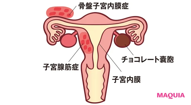 子宮内膜症ってどんな病気？