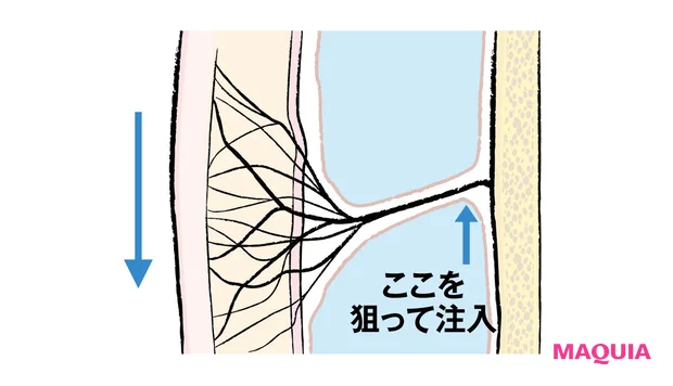 最新美容医療 ヒアルロン酸注入 リガメントを支えて補強する ビフォー