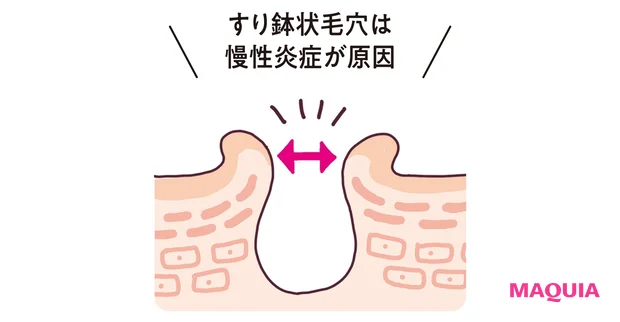 すり鉢状毛穴は慢性炎症が原因