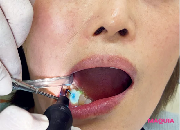 歯周病の事実 最先端治療 ブルーラジカル 施術画像