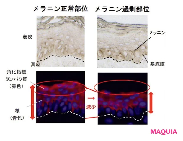メラニン過剰部位では肌内で滞留したり、方向が乱れて彷徨いメラニンが増加。シミだけでなくシワなど複合的な老化サインの原因に。