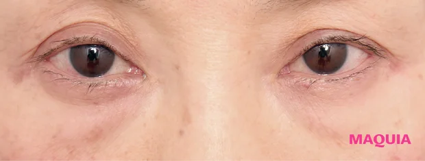 茶くまにおすすめの美容医療の治療 ヒアルロン酸注入 ビフォー