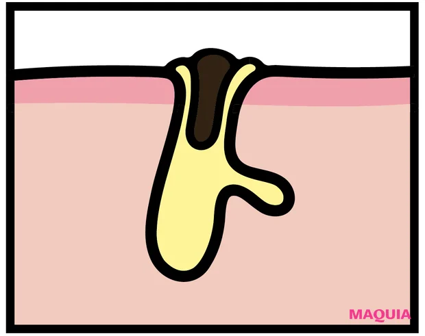 「頑固な黒ずみ毛穴」のおすすめ成分、NGケアをレクチャー。なかなか落ちない場合は産毛の可能性も？_2