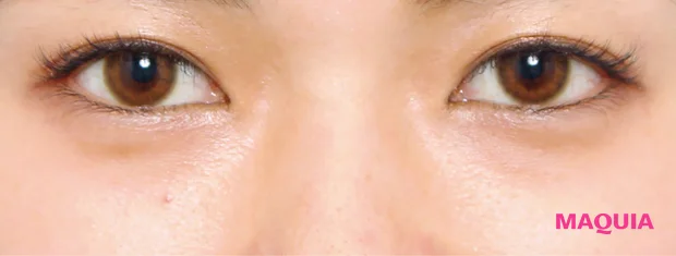 茶くまにおすすめの美容医療の治療スキンリファインピーリング アフター 3か月後