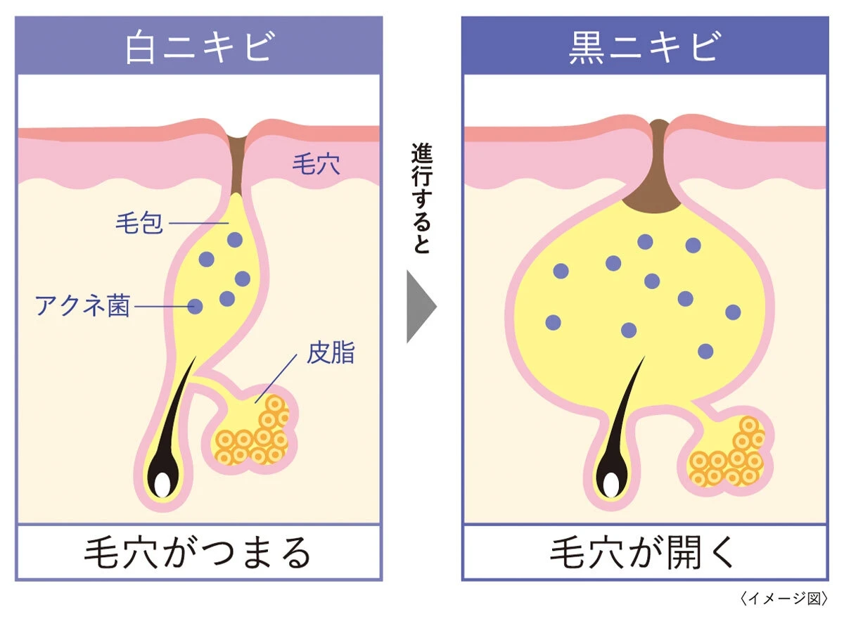 無限ループするしつこい大人のニキビを集中治療! ニキビに悩む人に寄り添う「マキロン アクネージュ」_3