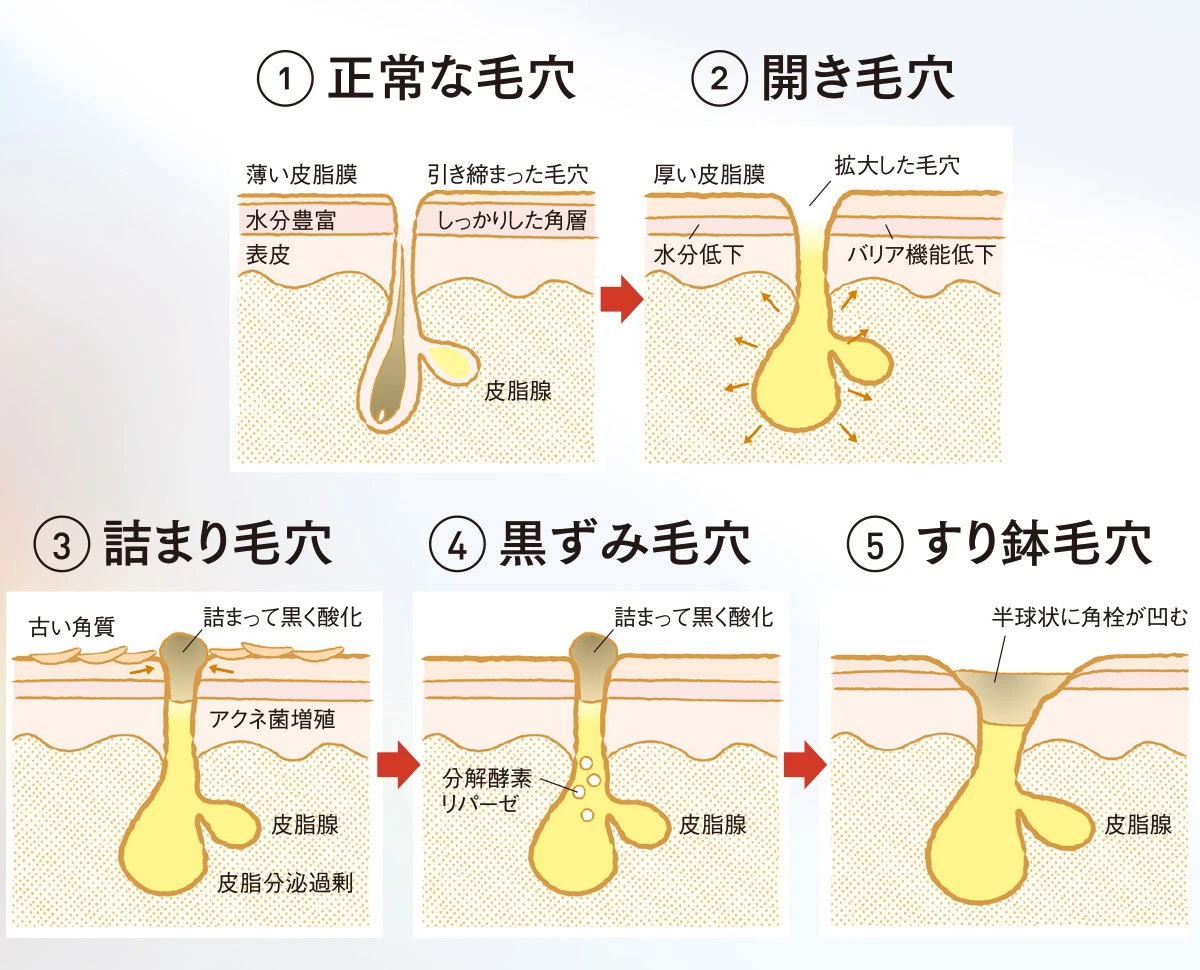 毛穴悩みの原因の2つは「角栓の詰まり」と「角質肥厚」です。