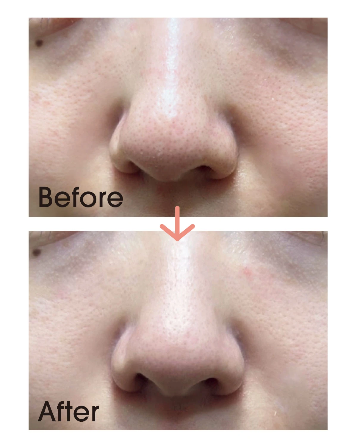 【詰まり毛穴】に悩むさきぴんさん(マキアインフルエンサー)before after