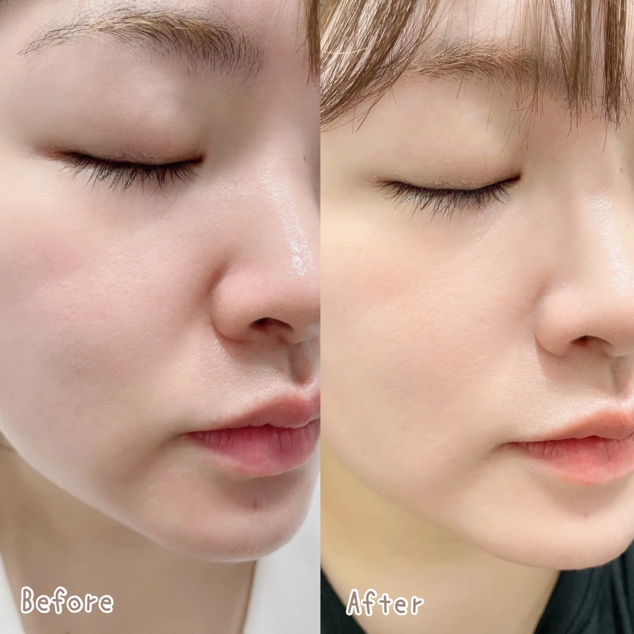 VT COSMETICS シカレチA エッセンス0.1 2週間使用 Before/After