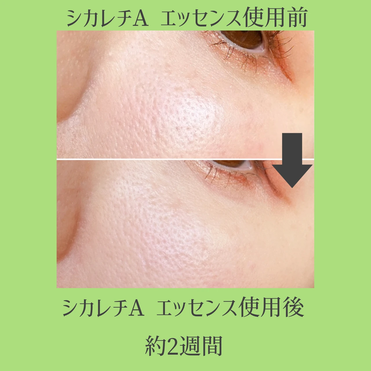 敏感肌でも使えるレチノール美容液！1日1CICA習慣で毛穴悩みをケア_3