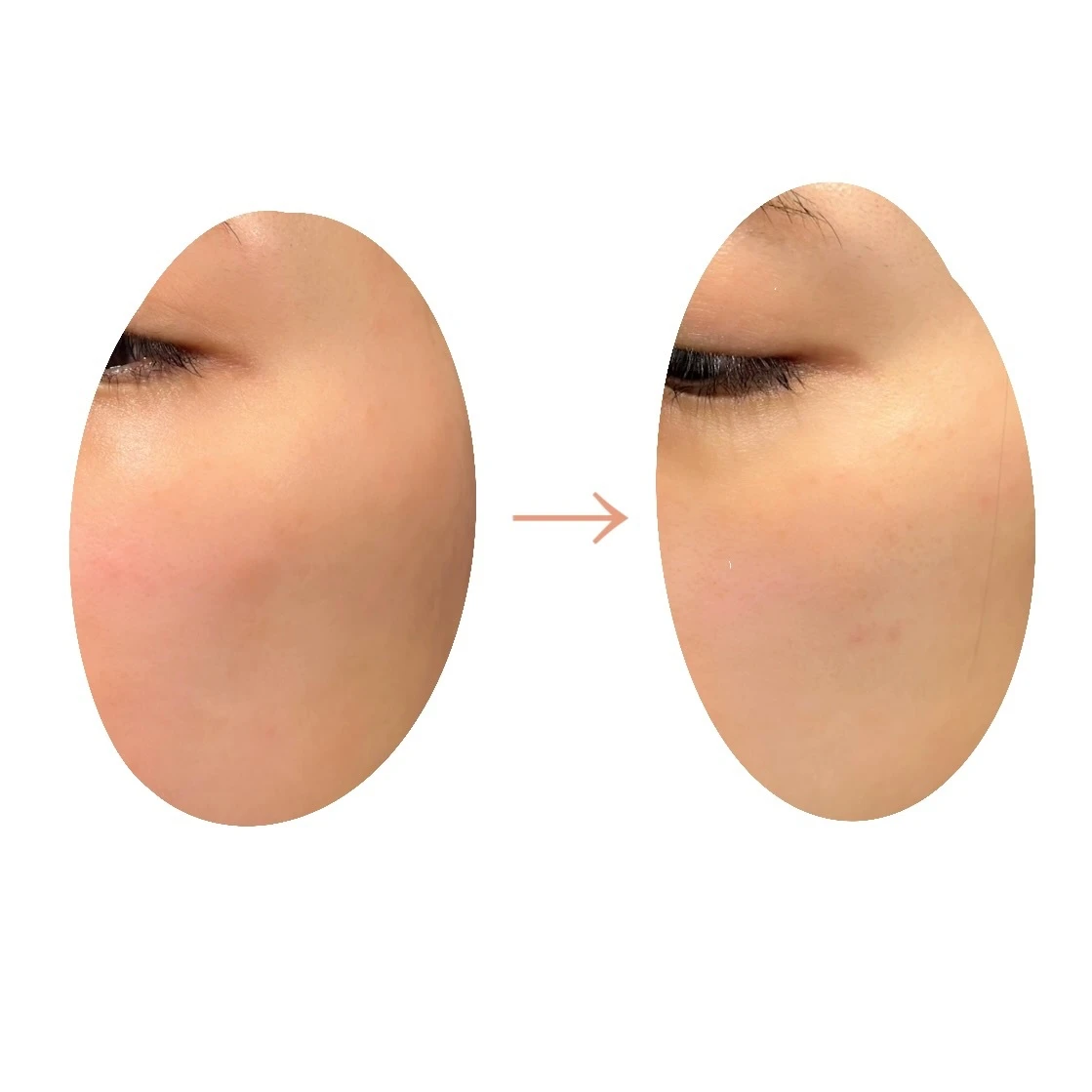 レチノール初心者にもおすすめ！VT cosmeticsのレカシチA エッセンス0.1✨_4