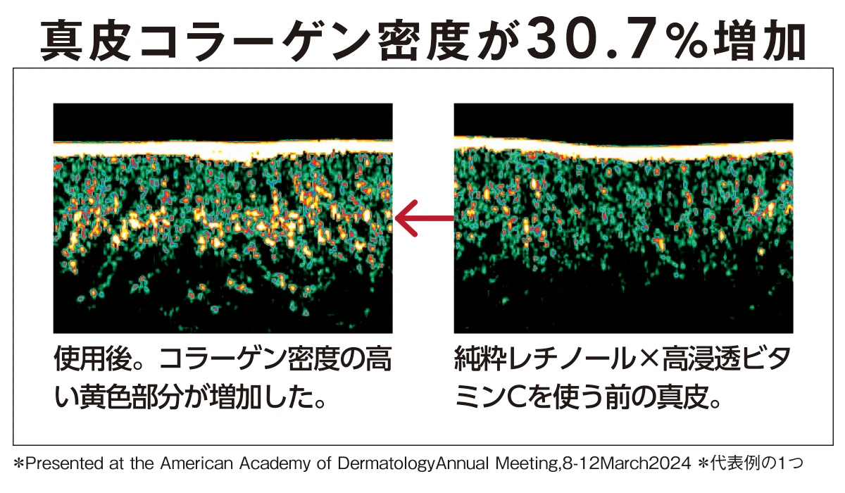 純粋レチノール×高浸透ビタミンC の研究について発表