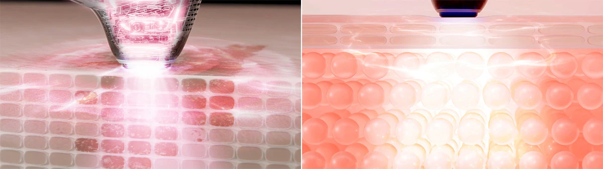 MYTREX　MiRAY ONE　フォト美容　光美容