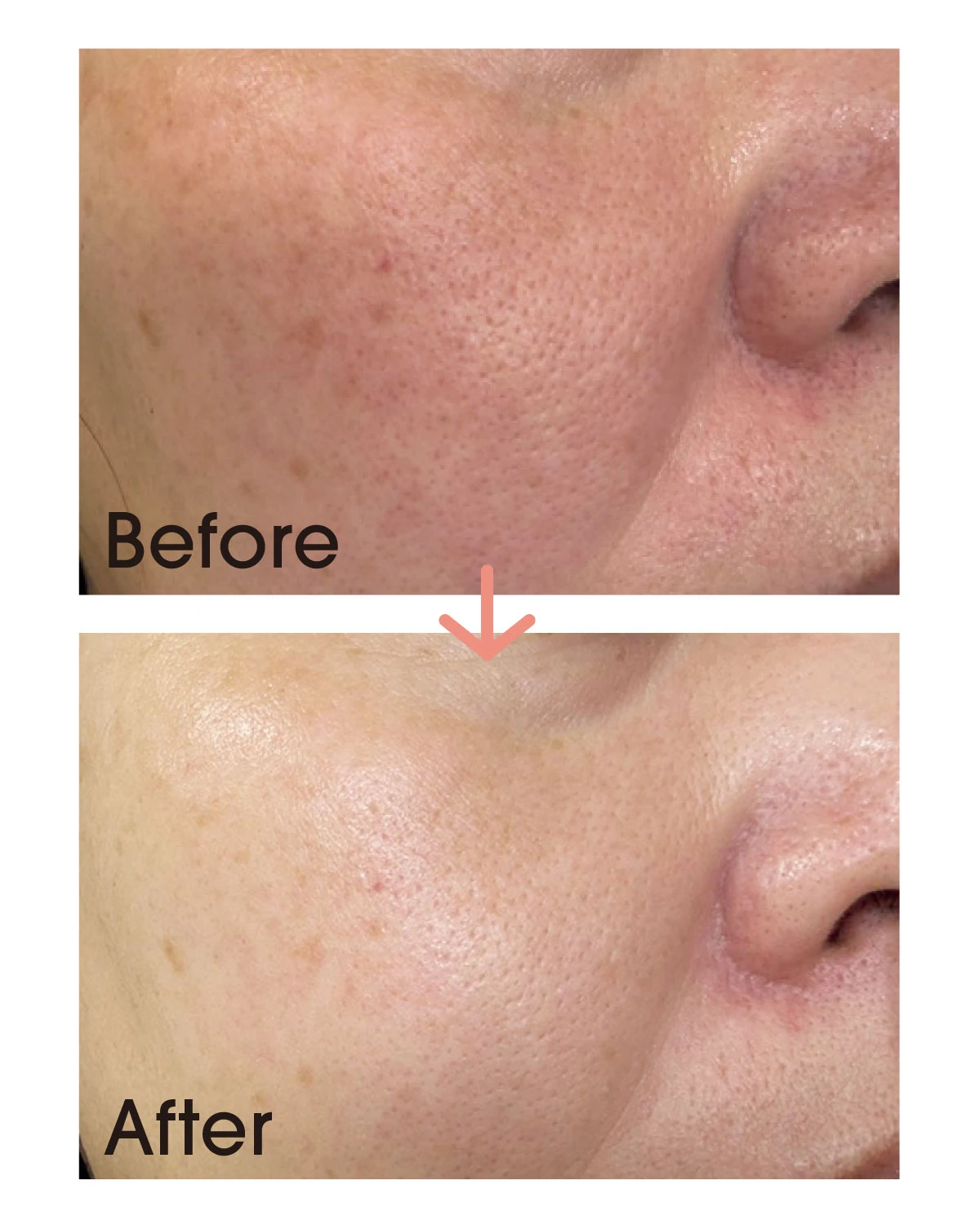 【乾燥毛穴】に悩む野崎さん(美容ライター)before after
