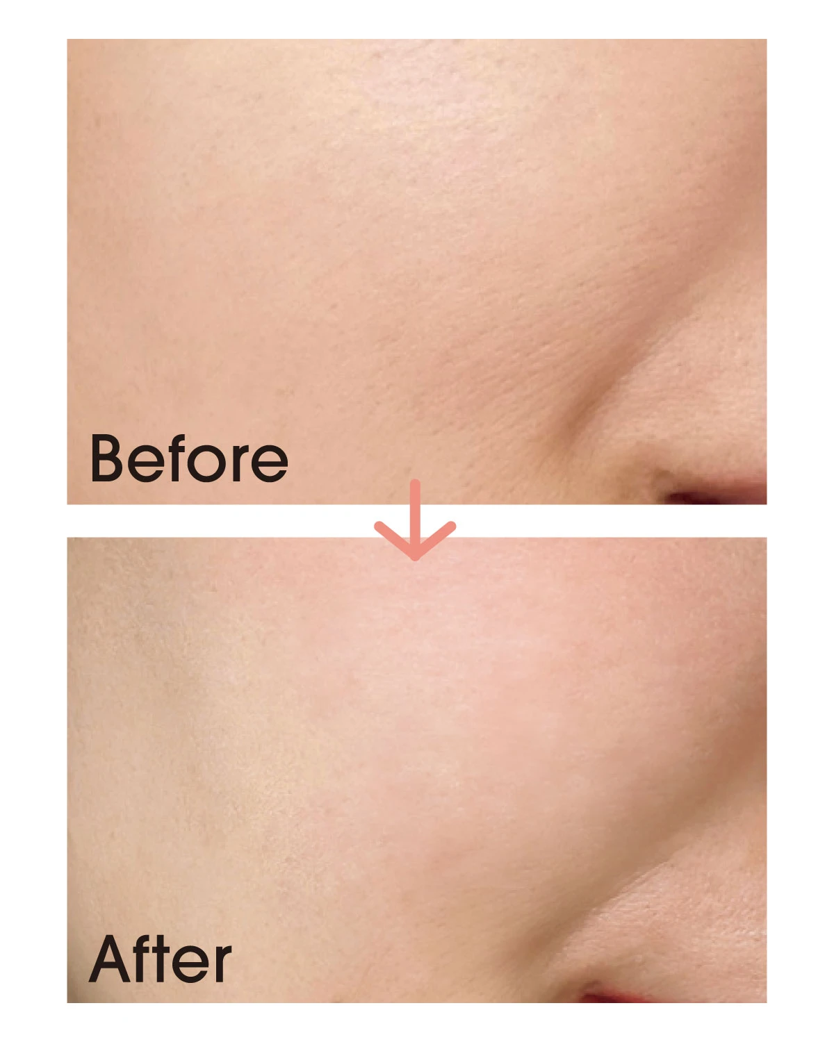 【乾燥毛穴】に悩むmadokaさん(マキアインフルエンサー)before after