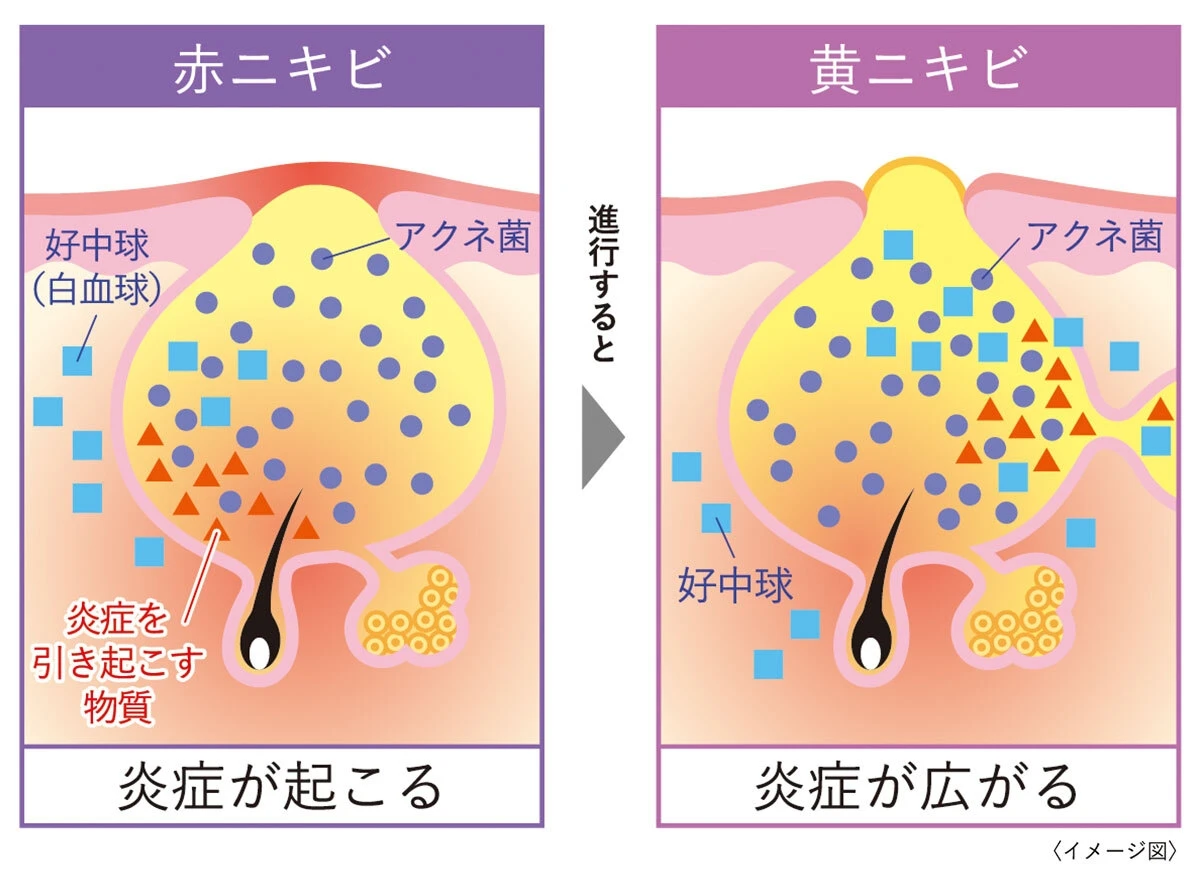 無限ループするしつこい大人のニキビを集中治療! ニキビに悩む人に寄り添う「マキロン アクネージュ」_4