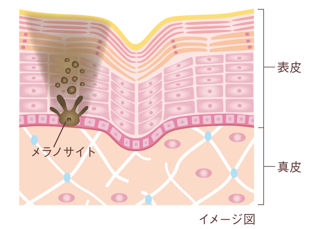 実は敏感肌だとシワに悩みがち!?