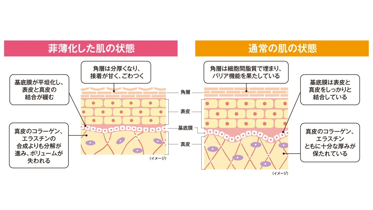 菲薄化とは… 表皮や真皮の厚みが減ることにより、 肌のボリュームが失われることです