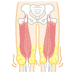 大腿四頭筋がひざ頭を支えきれず垂れ下がる