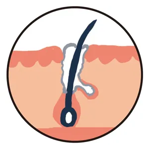 白つまり毛穴イメージ