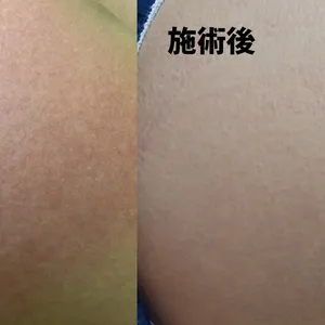 『肉割れ』ができる原因と対策を徹底リサーチ！ GALLERY_1_6