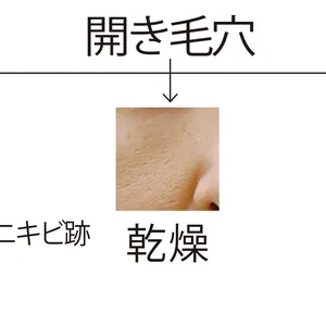 あなたのつまり毛穴はどれ？