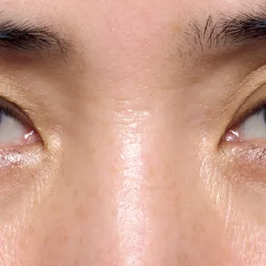 黒ぐま×たるみぐまタイプのくまカバー＆涙袋メイクのテクニック ビフォー