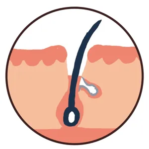 乾燥ぽっかり開き毛穴イメージ