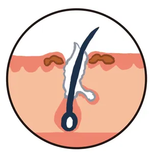 色素沈着茶つまり毛穴イメージ