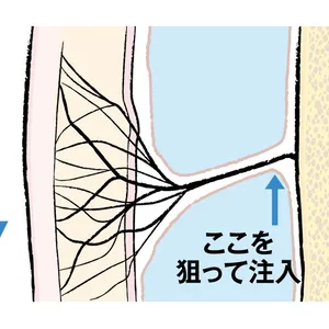 最新美容医療 ヒアルロン酸注入 リガメントを支えて補強する ビフォー