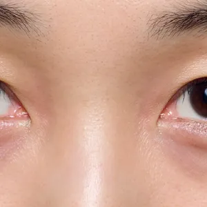 紫ぐま×たるみぐまタイプのくまカバー＆涙袋メイクのテクニック ビフォー