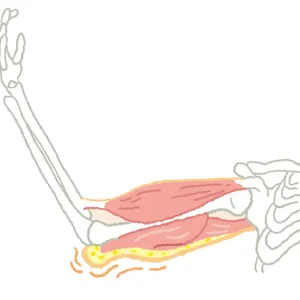 筋肉や脂肪のだぶつきがひじの上に流れつく