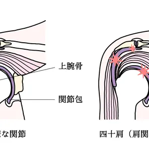 四十肩