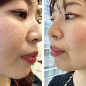 マキア　毛穴ケア　おすすめ　乾燥肌　赤み　肌状態