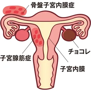 子宮内膜症ってどんな病気？